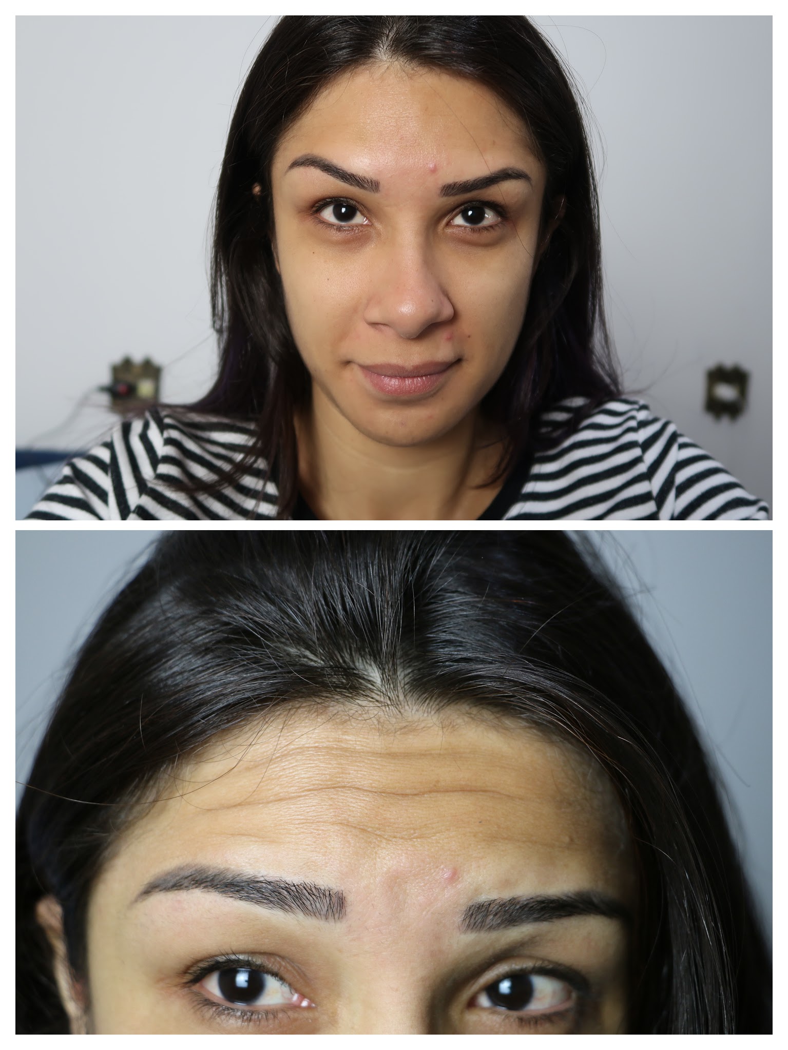 DIÁRIO DE BOTOX PRIMEIRA  APLICAÇÃO