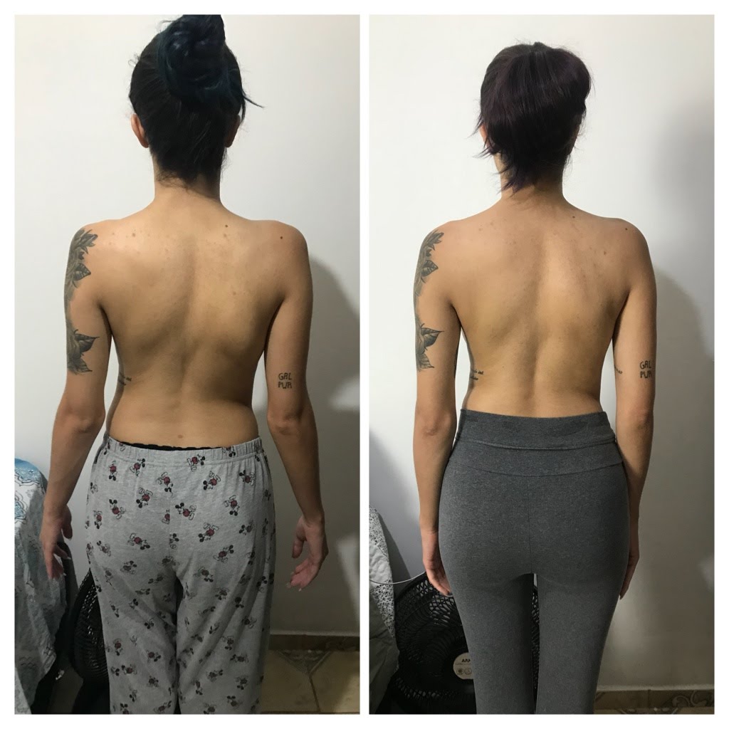 RESULTADOS DO PILATES PARA ESCOLIOSE