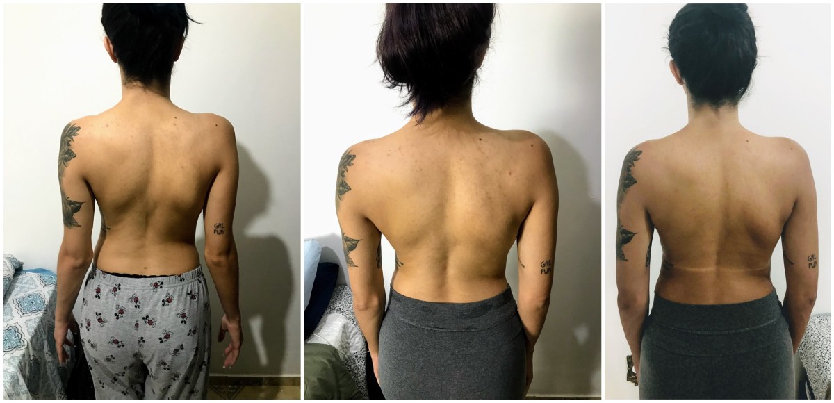 ESCOLIOSE | PILATES | AUTOACEITAÇÃO